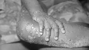 MONKEY-POX-IN-USA-AFTER-TWO-DECADES